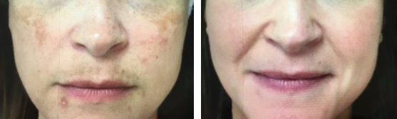 depigementation before and after