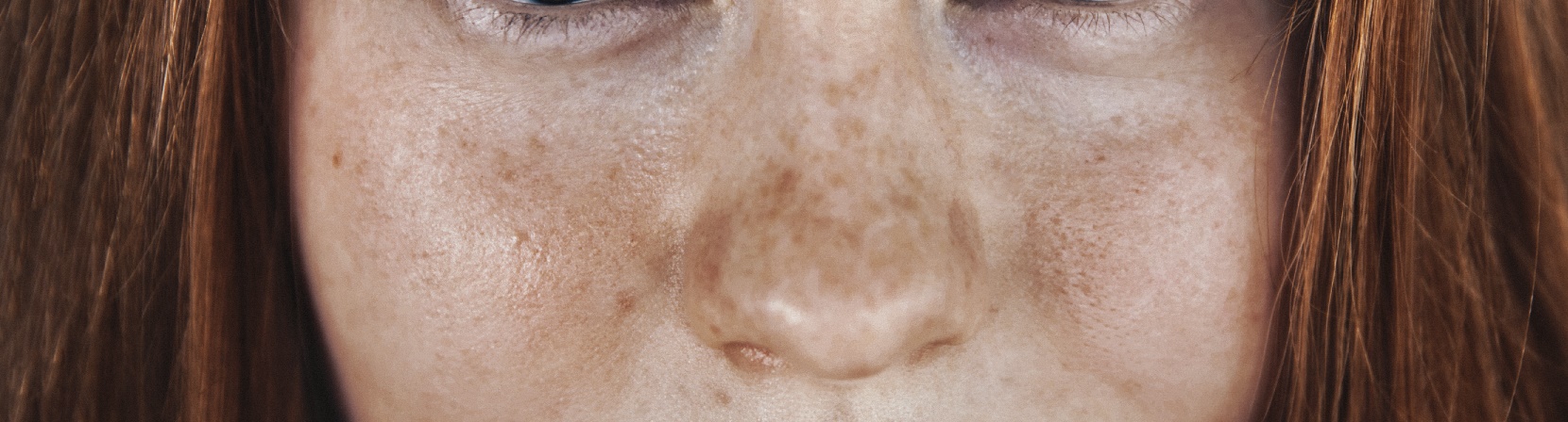what causes depigmentation and treatment