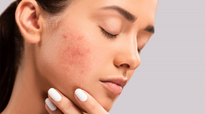A-Young-Woman-With-Red-Flushed-Skin-Rosacea